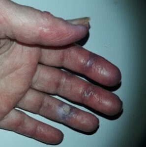 Durchblutungsstörungen an Fingern